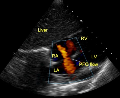 Patent foramen ovale or small atrial septal defect?