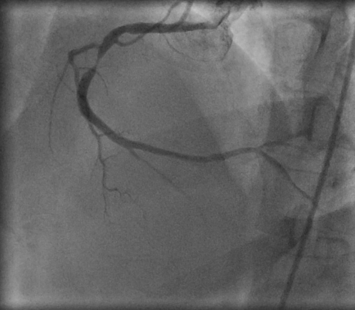 Tight discrete lesion of right coronary artery