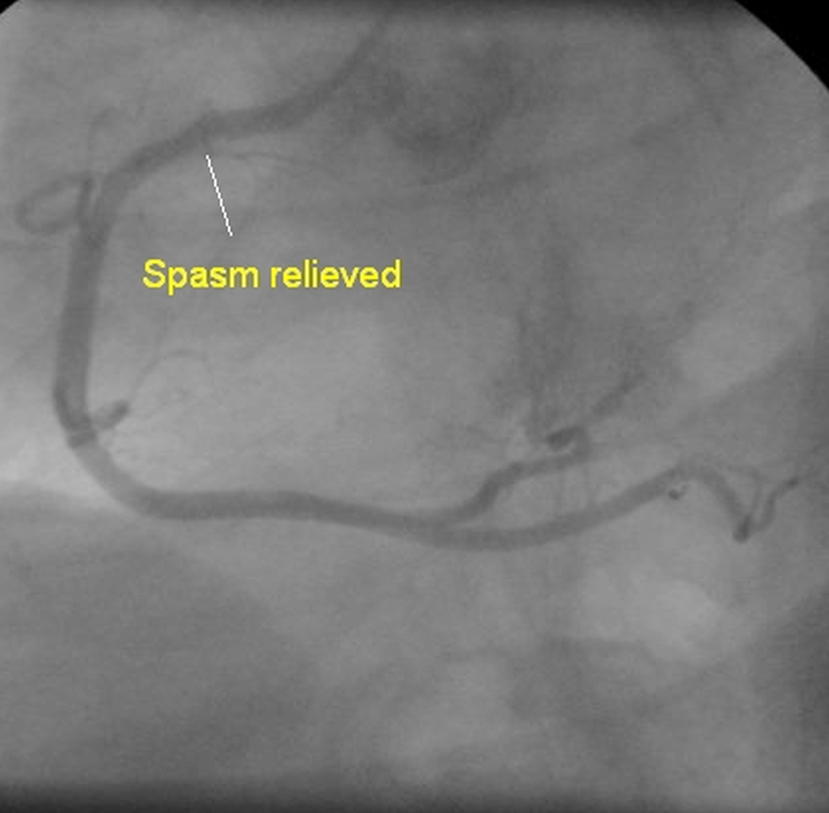 Spasm of right coronary artery relieved with nitroglycerine
