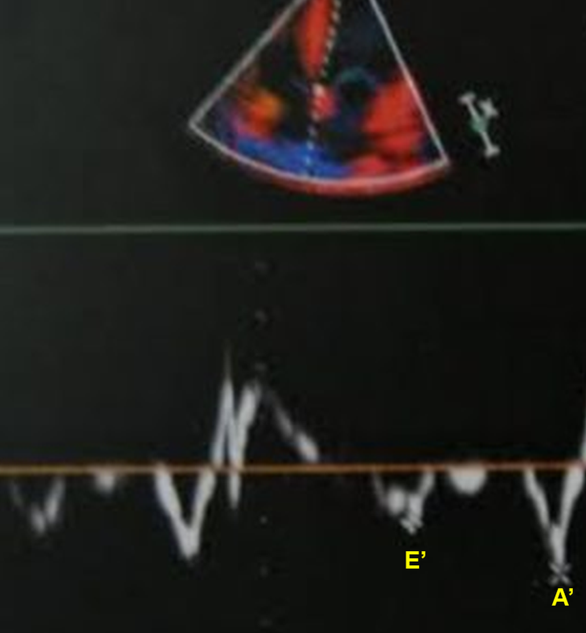 Tissue Doppler Imaging in HNOCM showing LV diastolic dysfunction