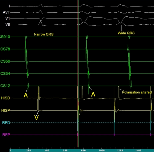 EP tracing during ventricular pacing
