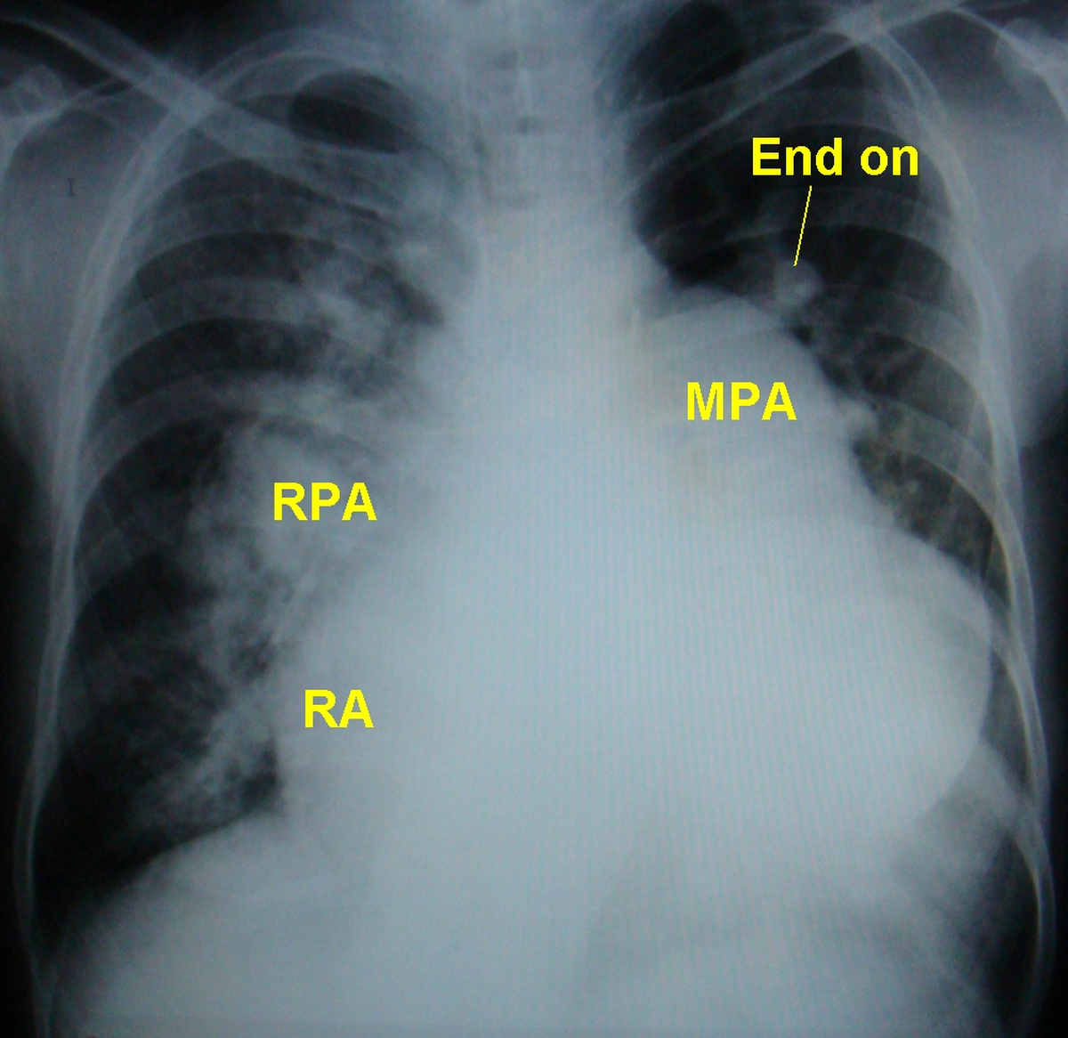 X-ray chest in atrial septal defect with pulmonary hypertension