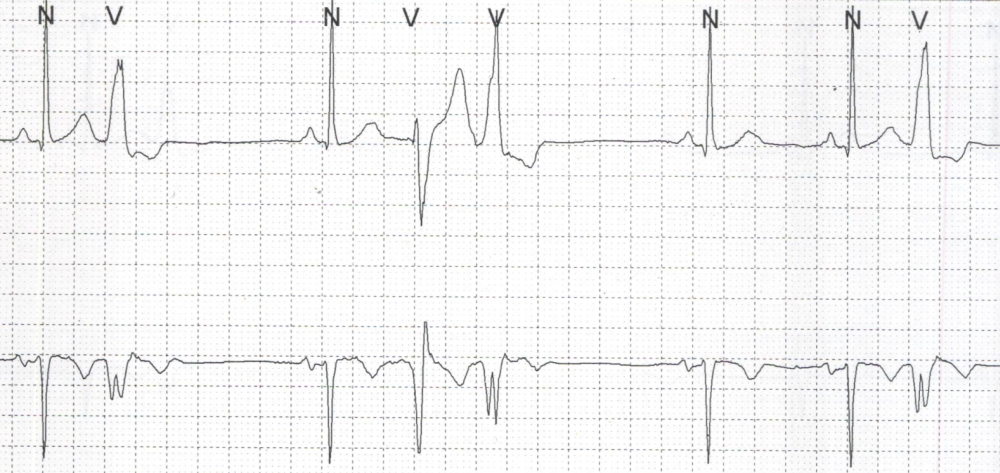 Polymorphic VPC on Holter