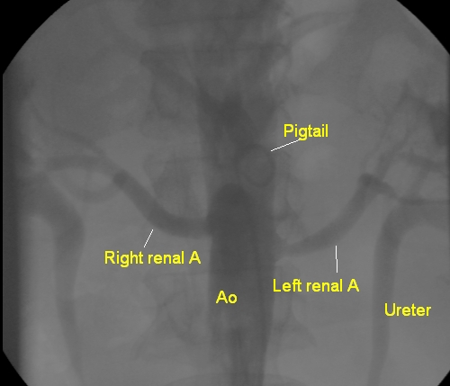 Descending aortogram showing renal arteries