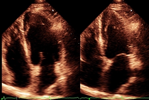 Systolic and diastolic frames from apical 4C view