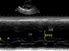 M-mode echocardiogram at mitral valve level
