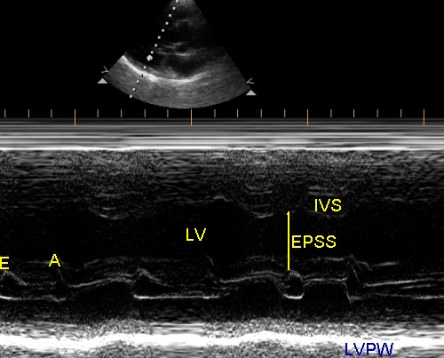 M-mode echocardiogram at mitral valve level
