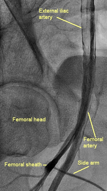 Femoral arterial sheath check shot - later frame