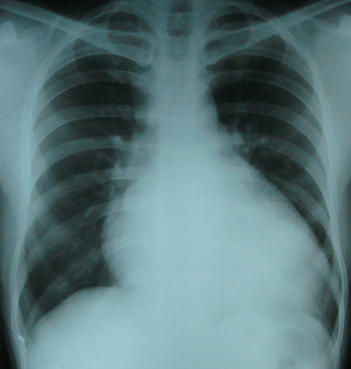 Cardiomegaly due to LV dysfunction on X-ray chest PA view