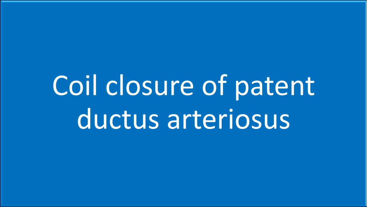 Coil closure of patent ductus arteriosus