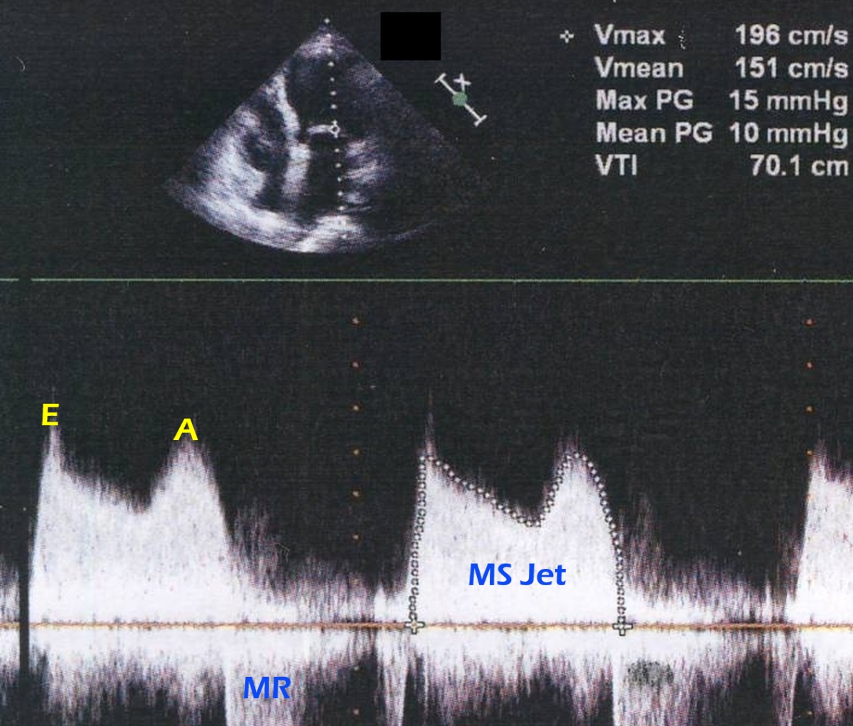 Mitral stenosis jet on continuous wave Doppler - annotated