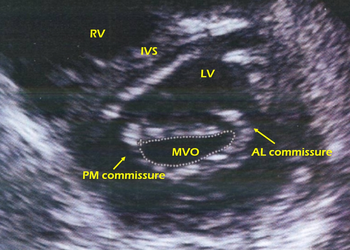 Echocardiogram in mitral stenosis showing commissural fusion