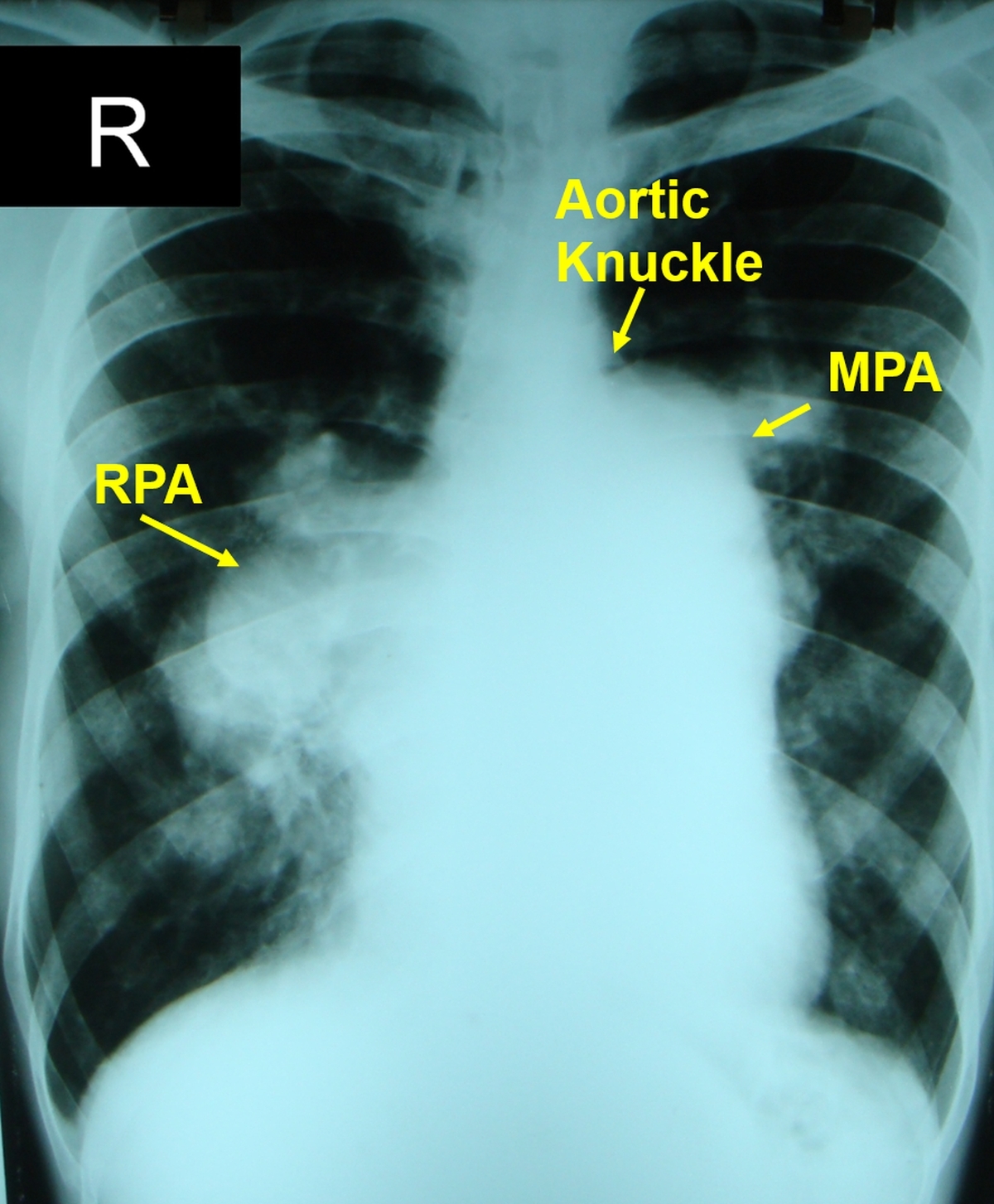 X-ray chest PA view in severe pulmonary hypertension (PAH)