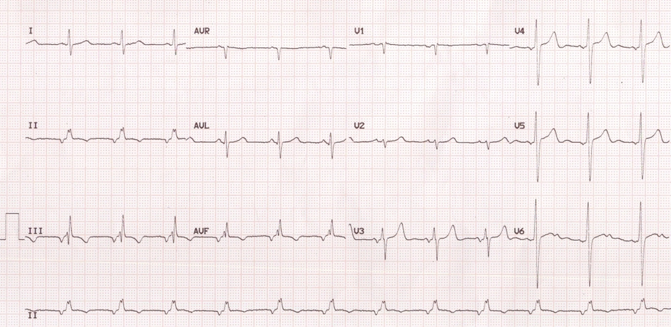 afib with ivcd