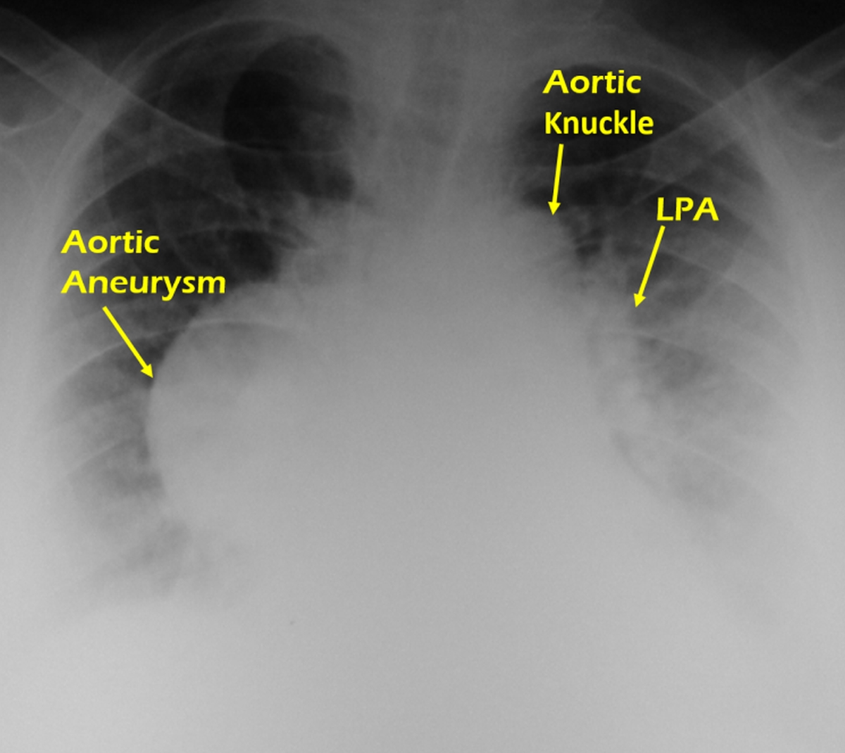 X-ray chest PA view in aortic aneurysm