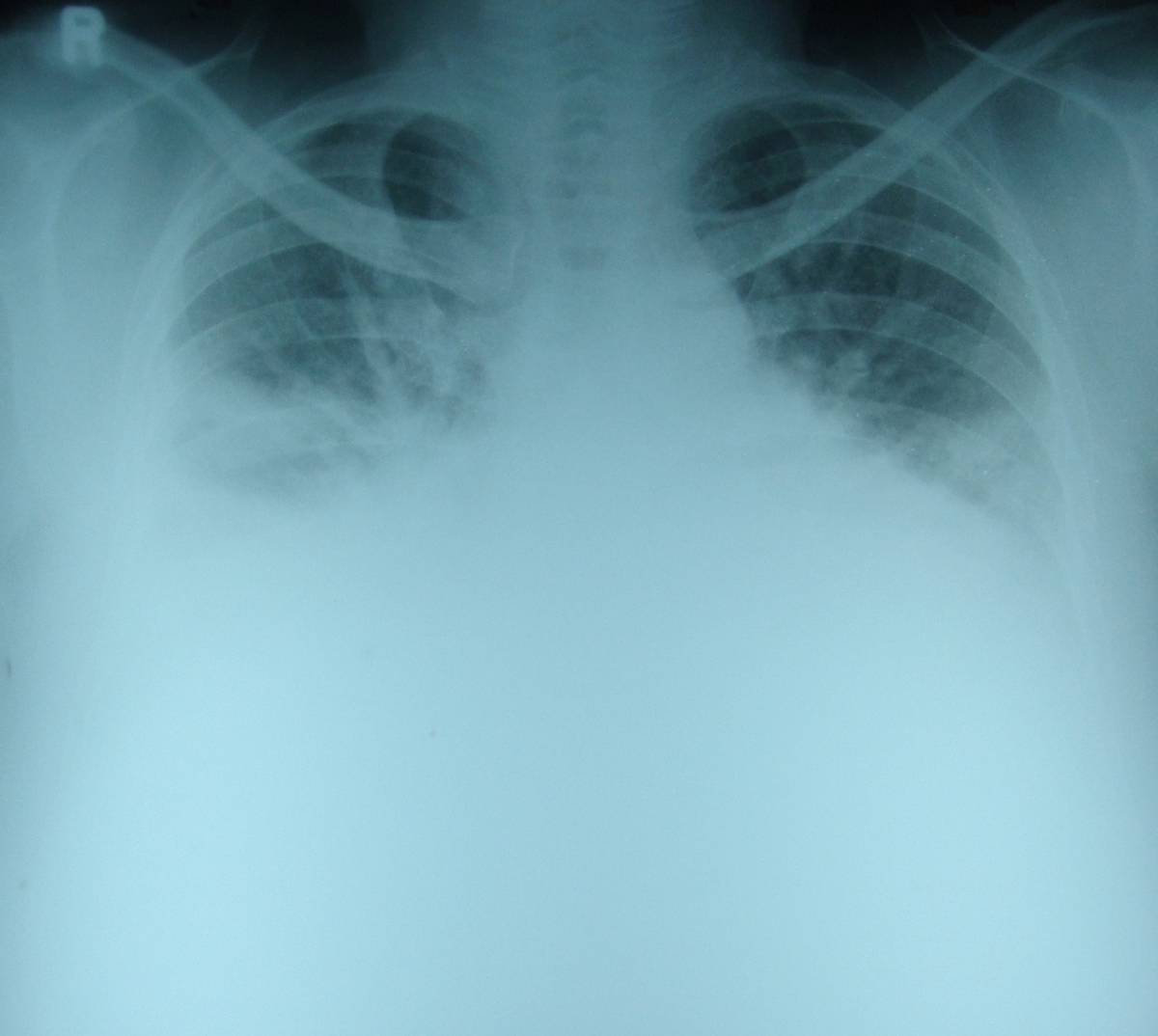 X-ray chest PA view in heart failure with bilateral pleural effusion