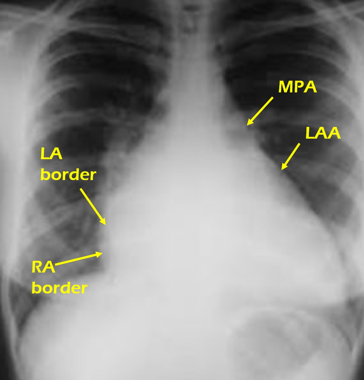 X-ray chest PA view showing biatrial enlargement