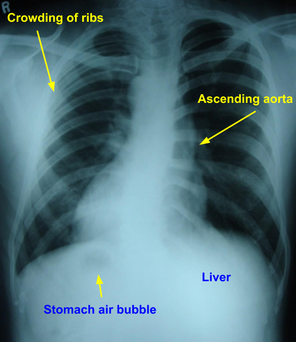 Dextrocardia and dextroposition