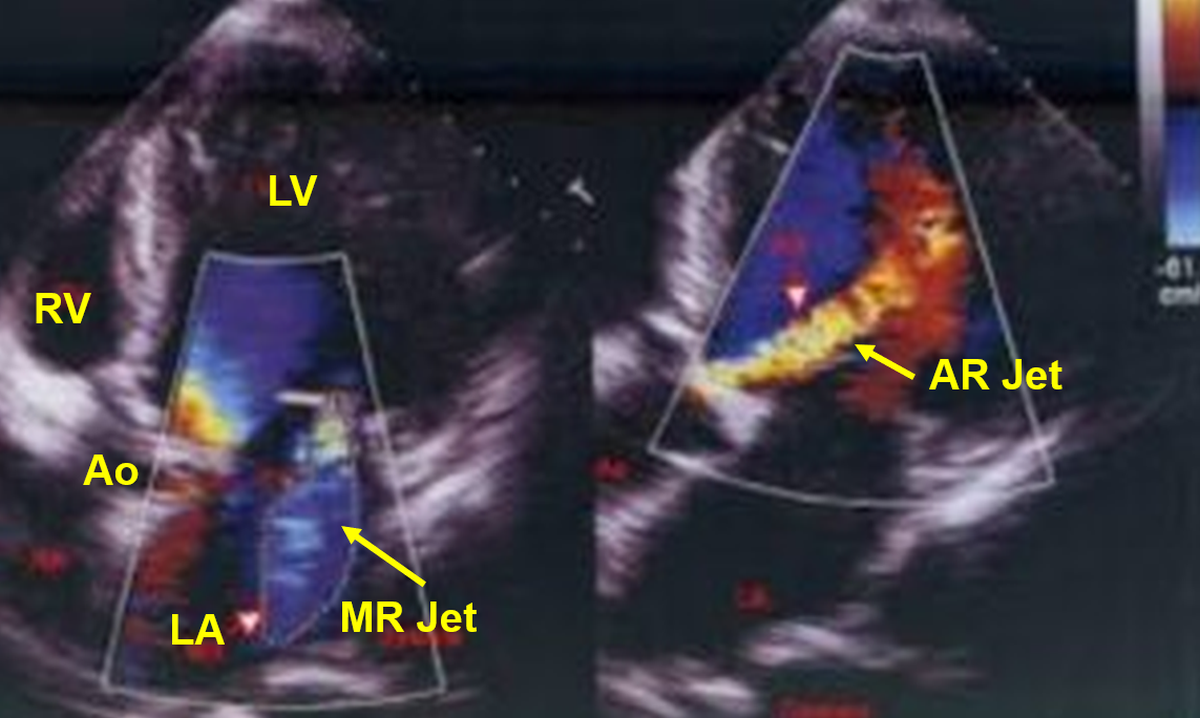 AR and MR - Colour Doppler echocardiogram