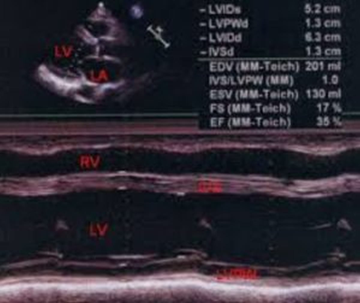 M-Mode echocardiogram in LV dysfunction