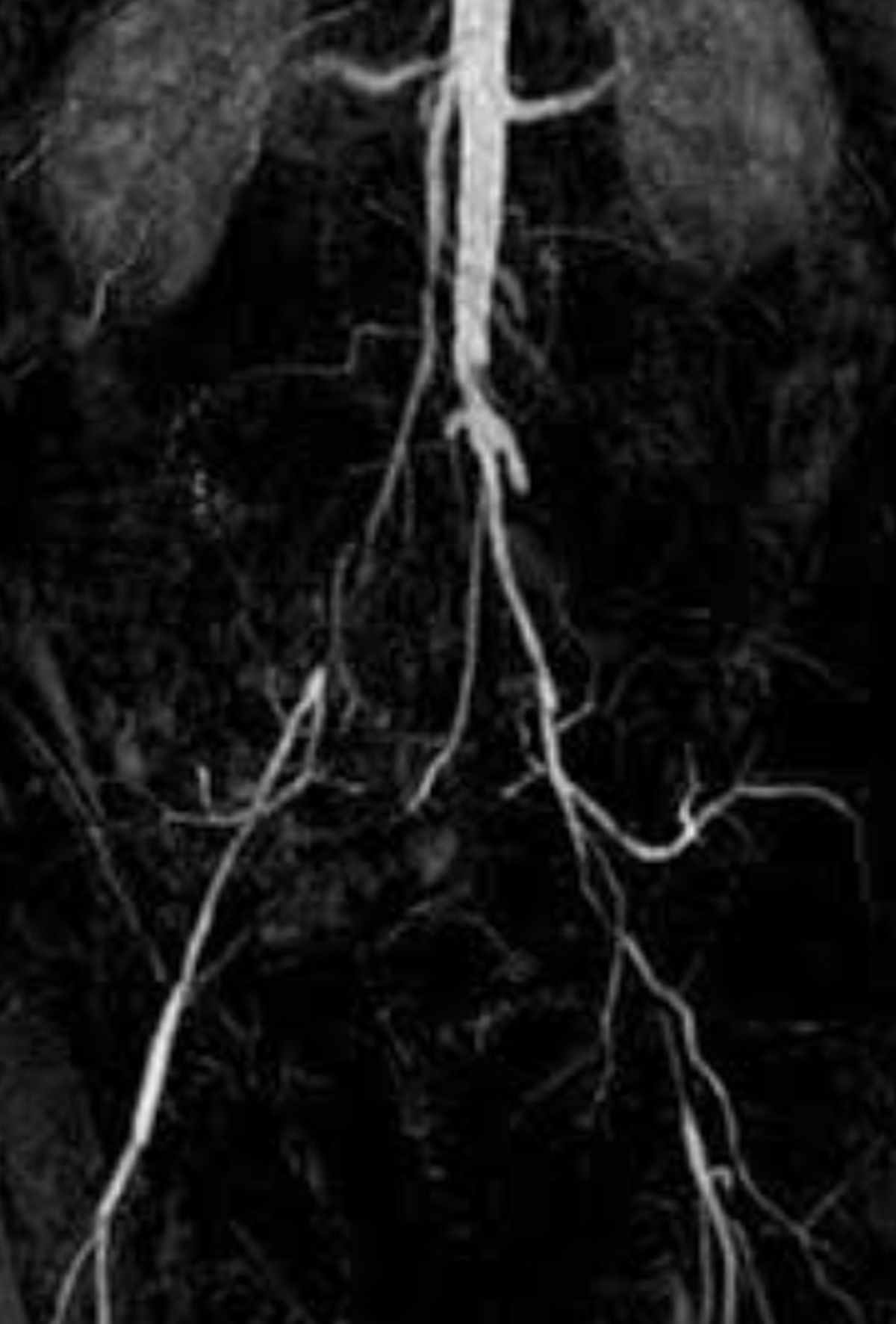MR angio in aortic bifurcation disease