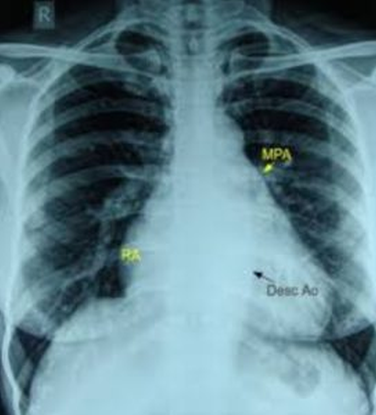Penetrated view of CXR