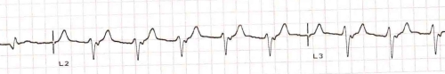 AIVR with regular retrograde P waves