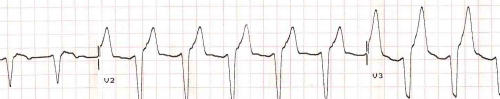 AIVR with evident wide QRS