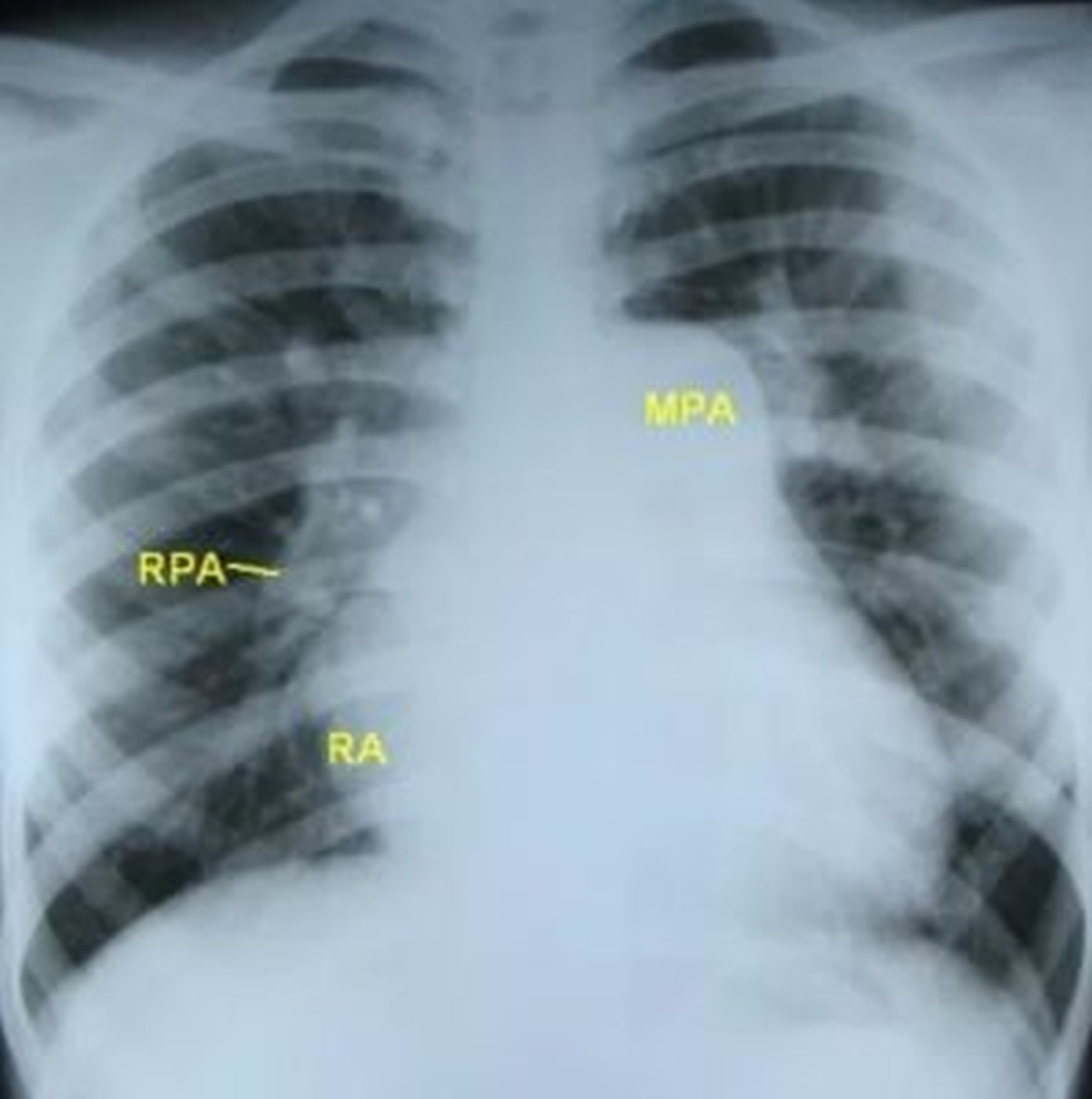 CXR in severe pulmonary hypertension
