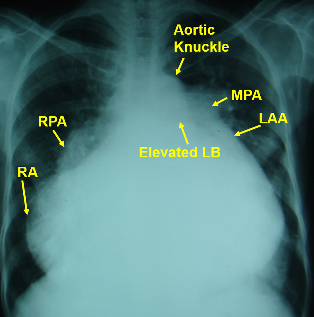 Gross cardiomegaly on CXR - Annotated