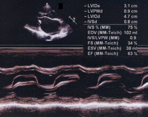 M-mode echocardiogram in severe mitral stenosis with flat EF slope