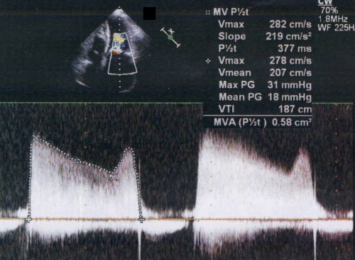 Mitral gradient by CW Doppler in mitral stenosis