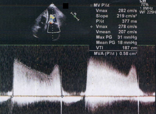 mitral-gradient-by-cw-doppler-in-mitral-stenosis-all-about