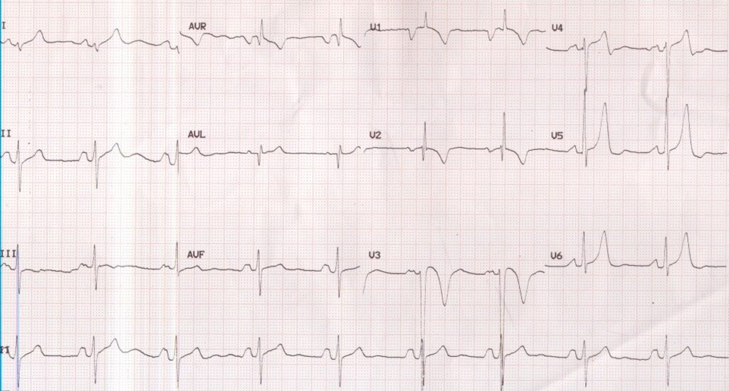 P Mitrale And Right Ventricular Hypertrophy All About Cardiovascular