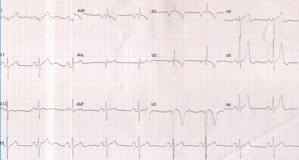 P mitrale and right ventricular hypertrophy