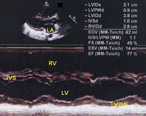 Dilated right ventricle on M-mode echocardiogram in severe pulmonary hypertension