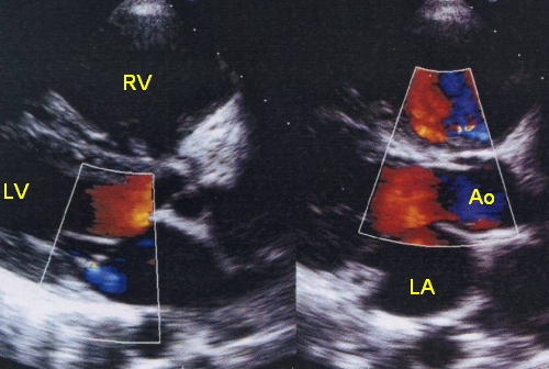 Dilated right ventricle on echocardiogram PLAX view in severe pulmonary hypertension