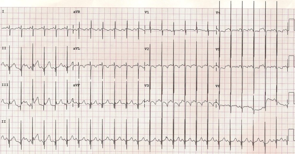 Katz-Wachtel phenomenon / sign on ECG in VSD