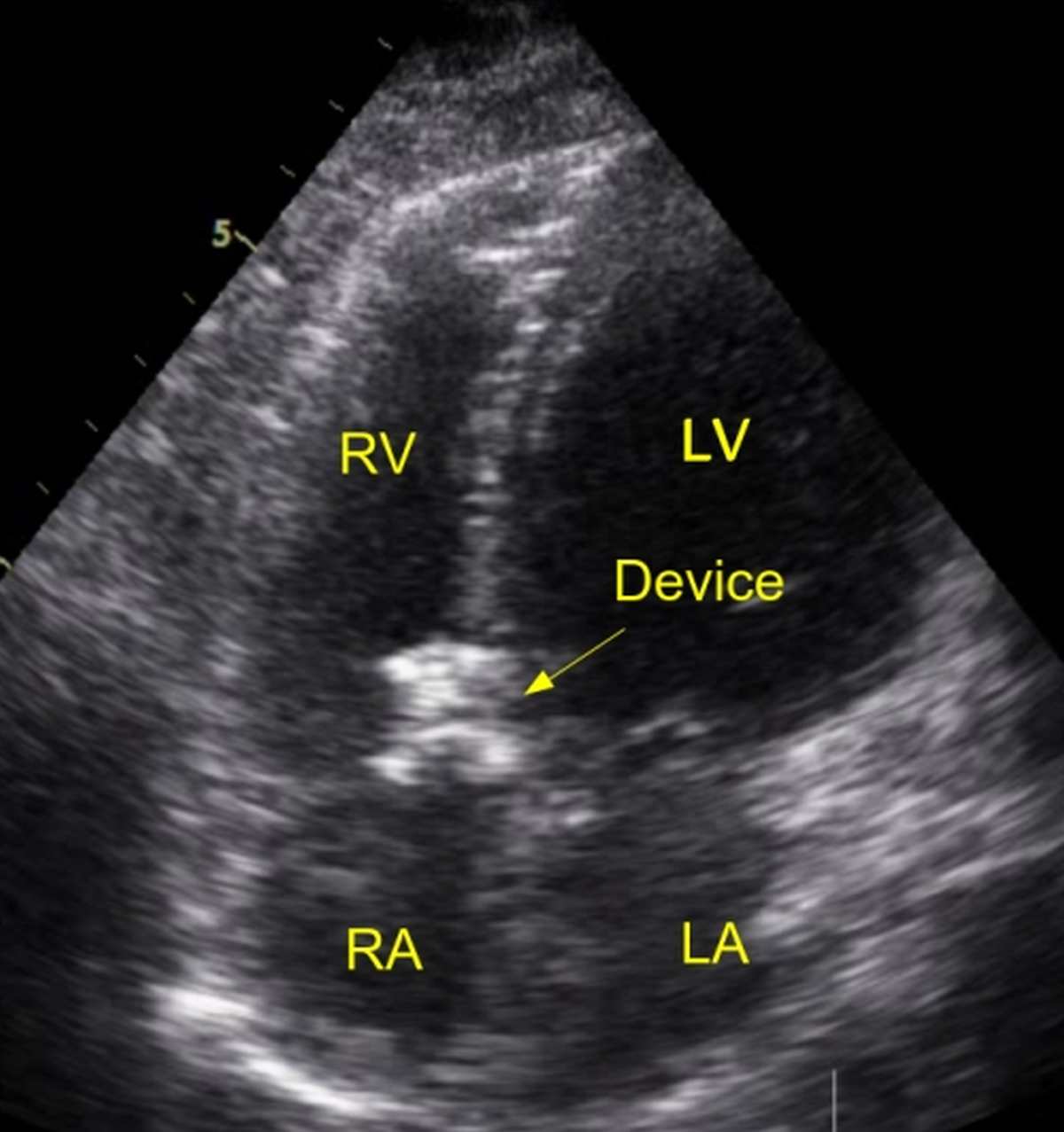 Device closing RSOV on echocardiogram