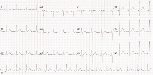 Repeat ECG after three days showing disappearance of pre-excitation