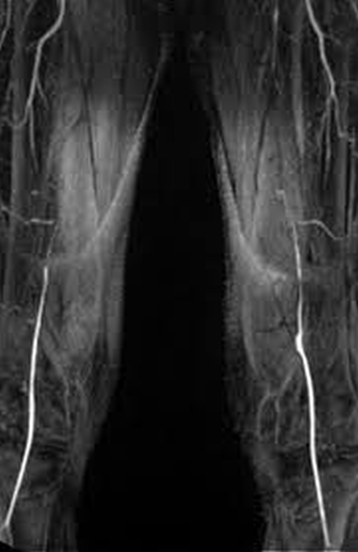 MR angio of femoral and popliteal arteries