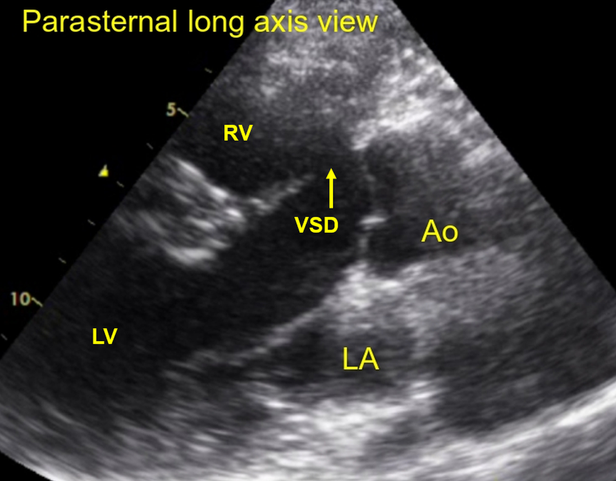 Subaortic VSD with aortic override