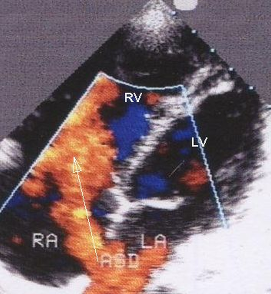 Atrial septal defect (ASD) - colour Doppler echo and 2D echo