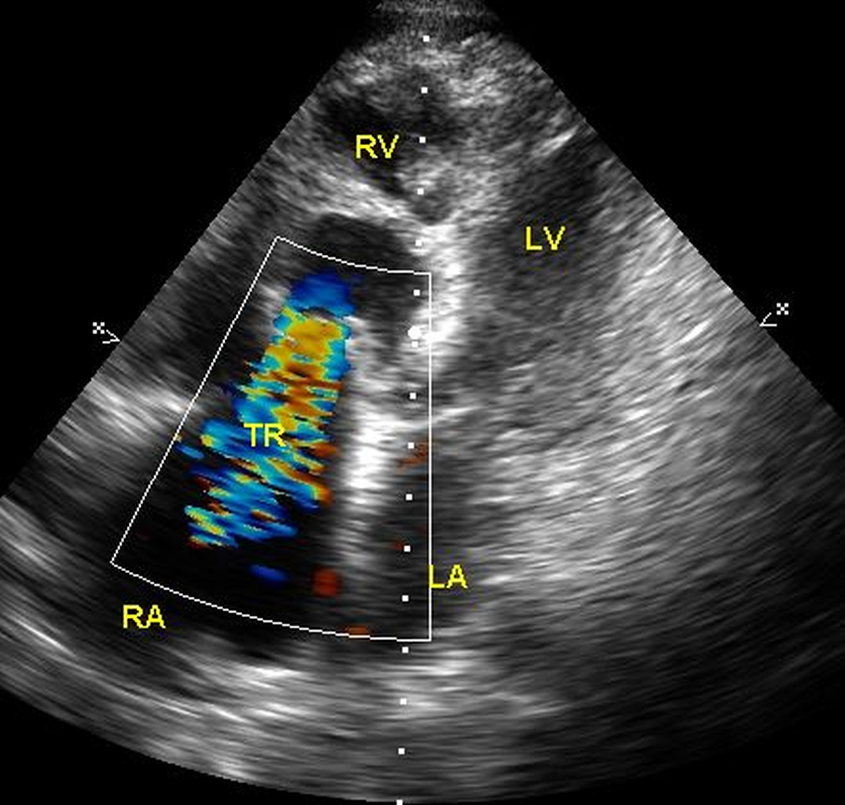 Colour Doppler in tricuspid regurgitation