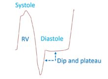 Dip and plateau in ventricular pressure tracing in constrictive pericarditis