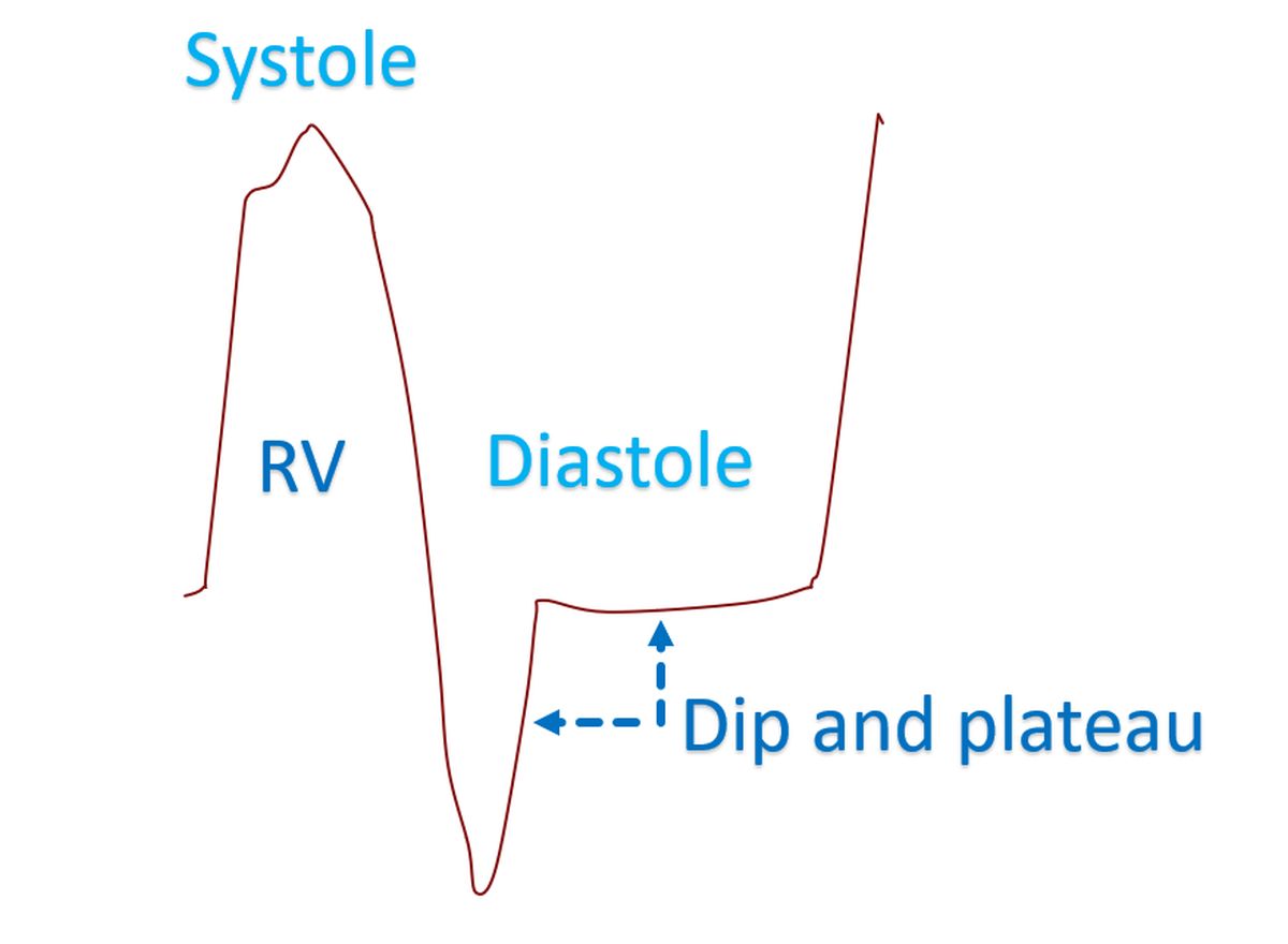 Dip and plateau in ventricular pressure tracing in constrictive pericarditis