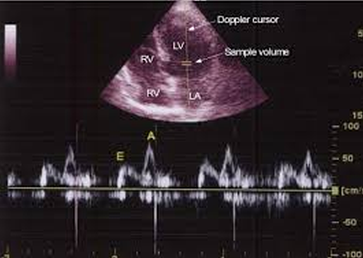 Doppler tracing of mitral flow in left ventricular diastolic dysfunction