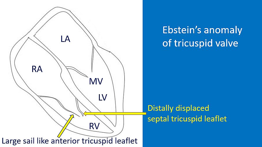 Ebstein anomaly of tricuspid valve