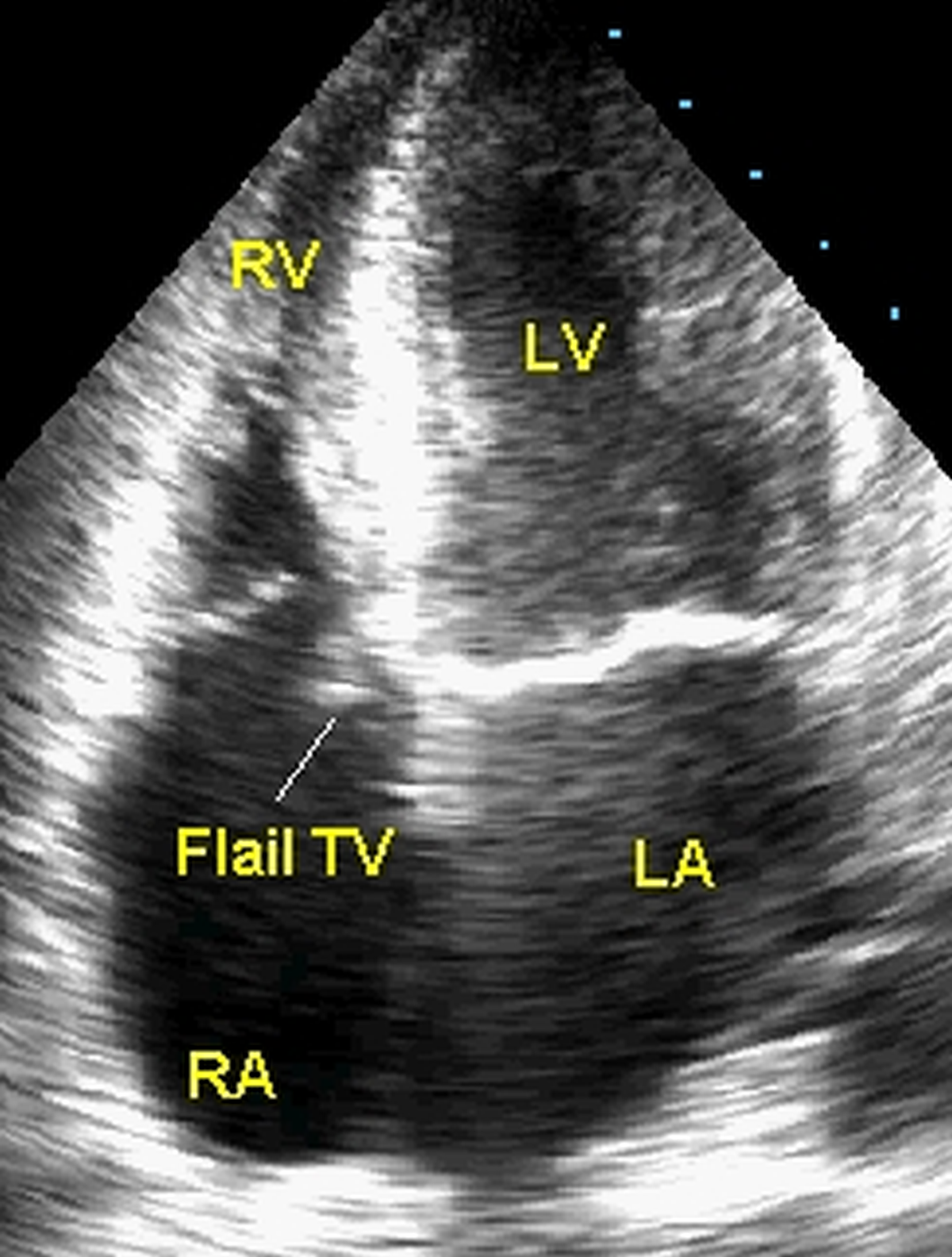 Flail septal leaflet of tricuspid valve