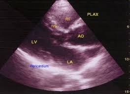 Parasternal long axis view in echocardiography